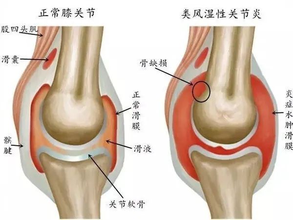 中醫(yī)定向透藥治療儀對關節(jié)炎的治療.jpg